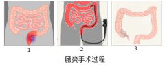 慢性肠炎的症状是什么？大连开发区肛肠医院